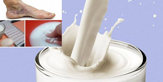 Süt ile varis tedavisi