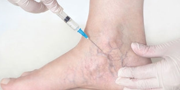  Süt ile varis tedavisi resmen doğal ilaç