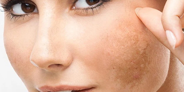 Suyla karıştırıp yüzünüze sürün: Güneş lekelerini silgi gibi siliyor!