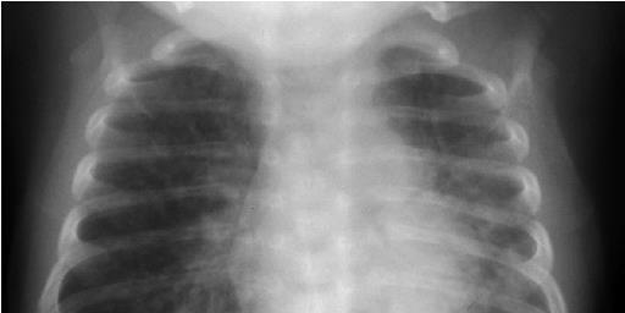 Takipne hastalığı nedir, nasıl tespit edilir? Tedavi için ne yapmalı…