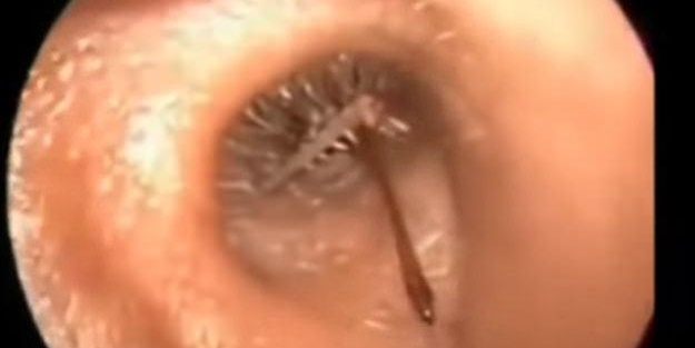 Talihsiz adamın kulağından böcek çıkarıldı!