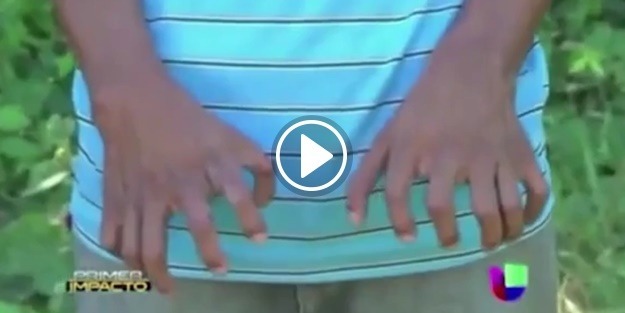 Tam 26 parmağı var!