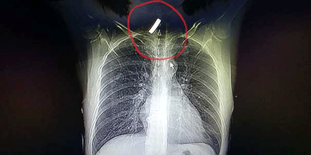Tam 4 santim, 15 ay boyunca boğazında bununla yaşadı!