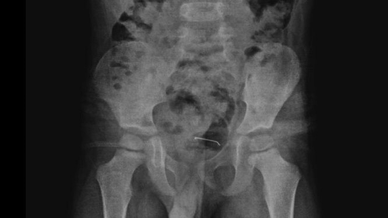 Tam 9 ay boyunca mesanesinde taşıdı! 5 yaşındaki çocuk bakın ne yutmuş