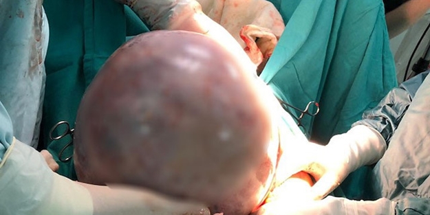 Tamı tamına 10 kilo! Solunum şikayeti ile gitti ama...