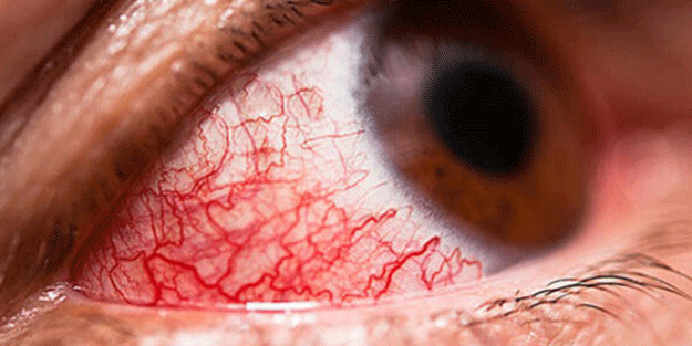 Tatilde bu hastalığa dikkat!