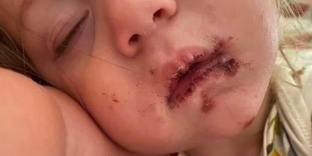 Tek bir öpücükle yüzü mahvolan bebek...