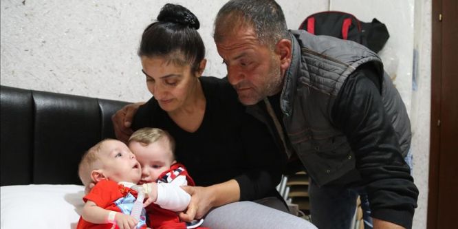 Siyam ikizleri birbirine kavuştu