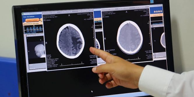 Beyin hücrelerinin yeniden programlanması Parkinson'a çare olabilir