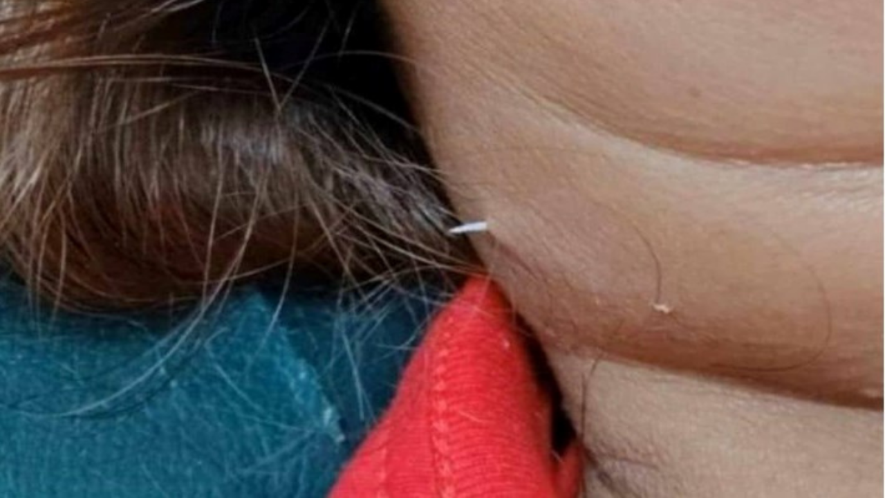 Tıbbi kayıtlara geçen olağanüstü olay: Yuttuğu kılçık iki hafta sonra boynundan çıktı!