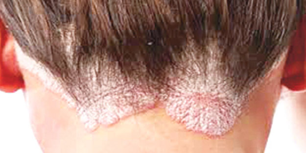 Tiksindiren illet: Sedef