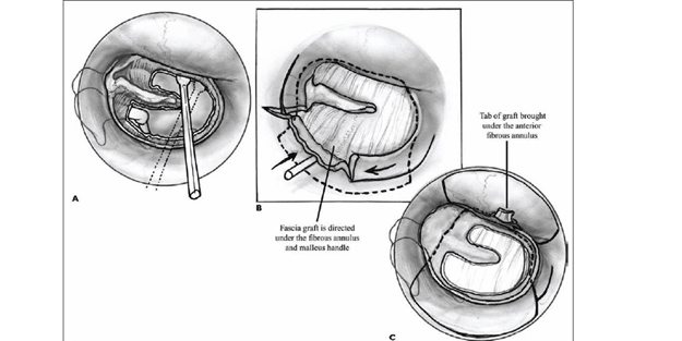 Timpanoplast ameliyatı nedir?