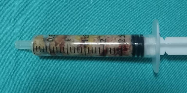 Tıp dünyası şaşkın! 13 aylık bebeğin böbreğinde bunun ne işi var?