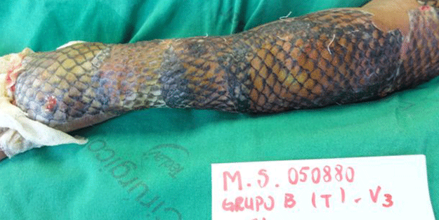 Tıpta devrim! Balık derisiyle kolunu kapladılar… Sonucu görünce inanamayacaksınız