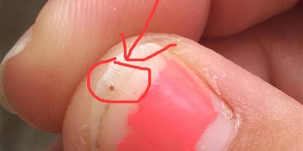 Tırnağındaki siyah noktadan şüphelendi! Bakın ne çıktı...