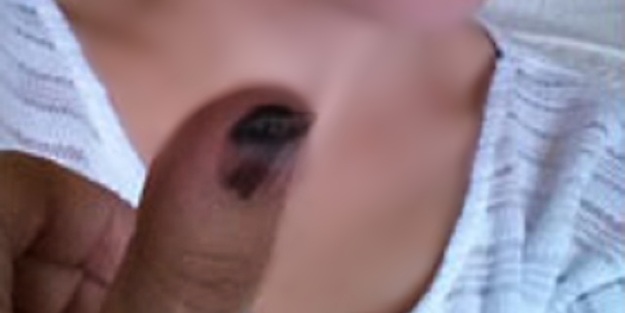 Tırnağınızda bu leke varsa dikkat