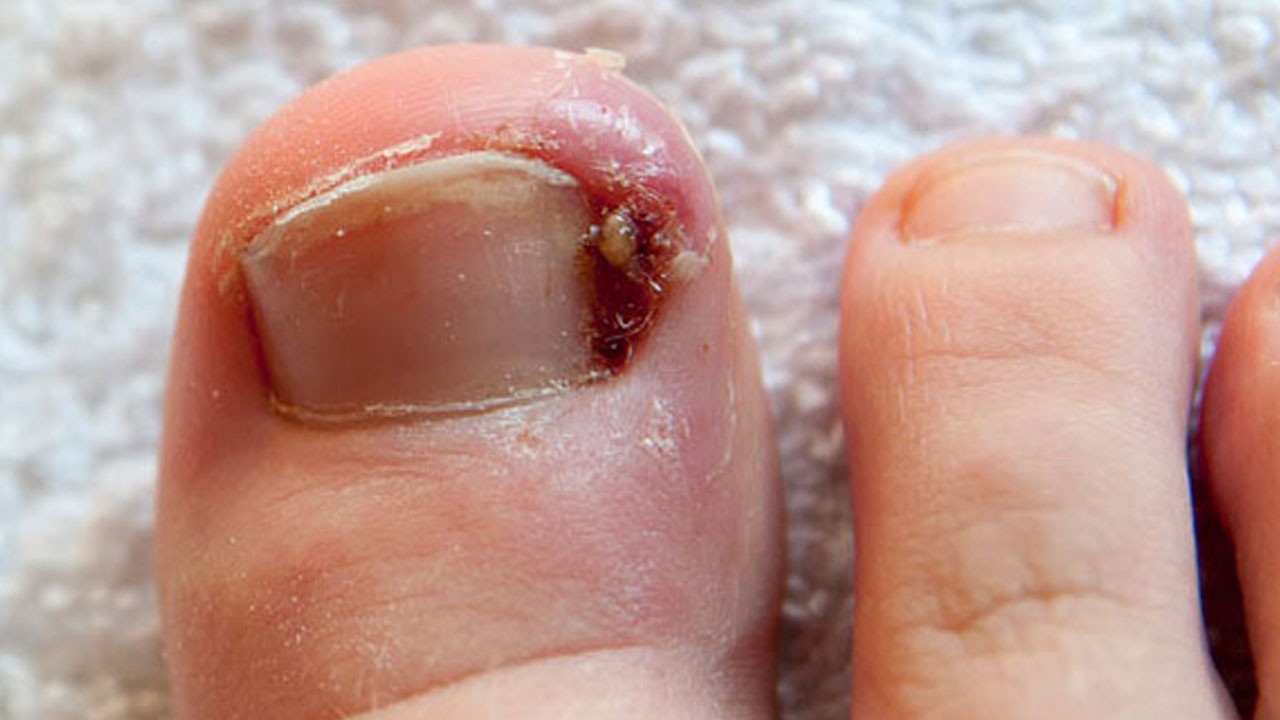 Tırnak batması hakkında merak edilenler: Son bulacak!