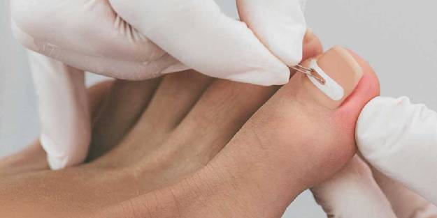 Tırnak batması neden olur ve nasıl iyileşir?