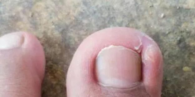 Tırnak batması soruna iyi giden karışım ortaya çıktı! 4 doğal yolda bitirmesi şok etti!