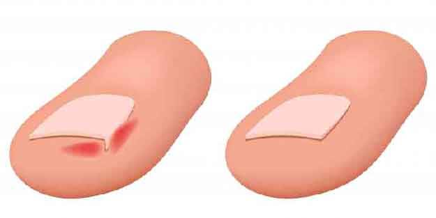 Tırnak batmasından ameliyat olmadan kurtulmanın yolu