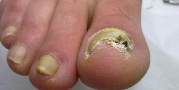 Tırnak mantarı nasıl geçer?