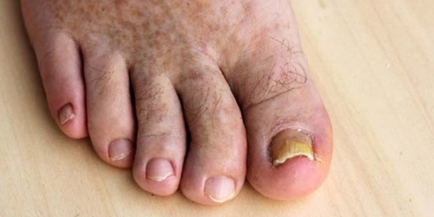 Tırnak mantarına doğal çözüm