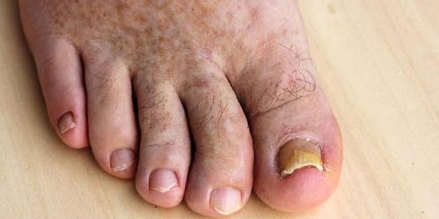 Tırnak mantarına doğal yöntemlerle dur deyin!