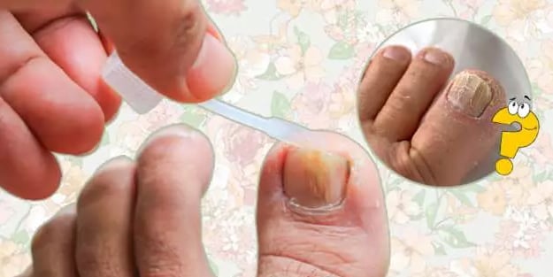 Tırnak mantarını yok eden doğal yöntem: 3 günde son verin! Nasıl önlenir? Kullananlar şikayetten vazgeçti