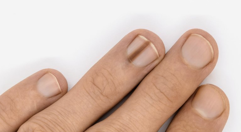 Tırnaklarda oluşan siyah çizgilerin anlamı nedir?