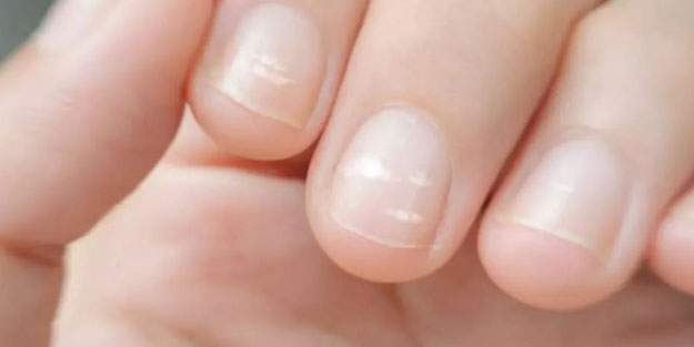Tırnaklardaki bu belirti hastalık habercisi olabilir