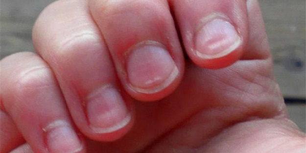 Tırnaklarınız böyleyse, dikkat!