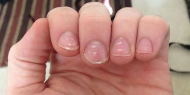 Tırnaklarınızda beyaz lekeler varsa, dikkat!