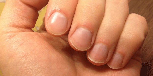 Tırnaklarınızdan hastalığınızı öğrenin