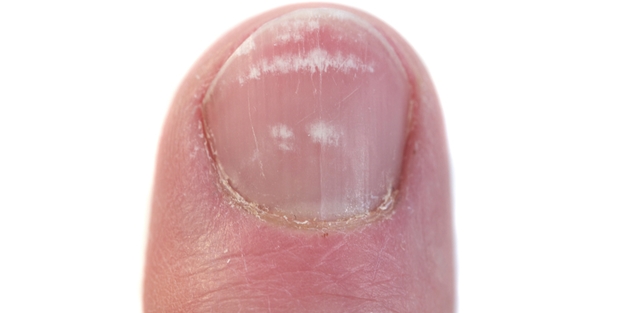 Tırnaktaki bu leke aslında... - FOTO