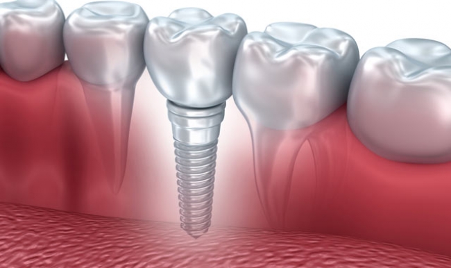 Titanyum implant kanser yapar mı?