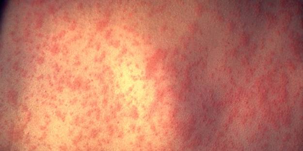 Togo'da kızamık alarmı!