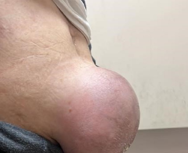 Top büyüklüğünde fıtık doktorları bile şaşırttı