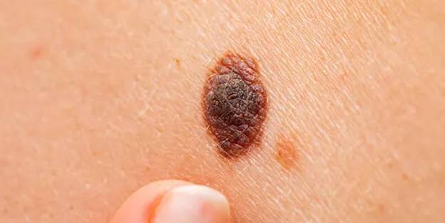 Toplumun yüzde 4’ünde görülen hastalığın sebebi henüz bilinmiyor