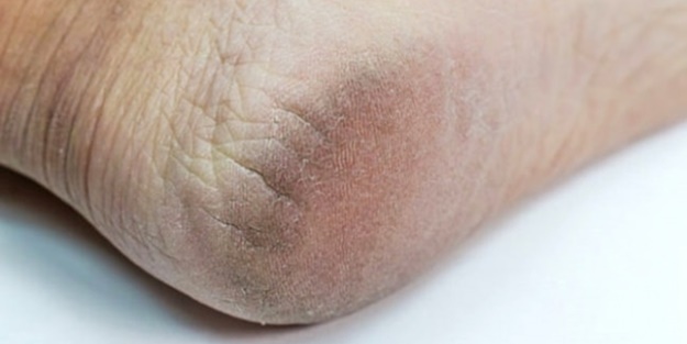 Topuk çatlakları ölümcül hastalığın belirtisi!