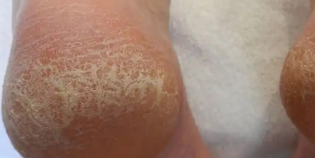 Topuk çatlaklarına 1 gecede elveda: öncesi ovalayın! Sonra kaderi değişecek! Hem ayağınızı hem bedeninizi temizliyor