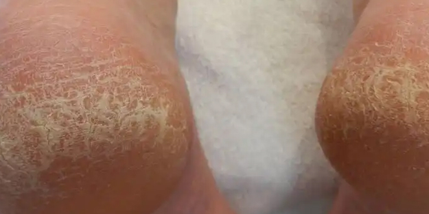 Topuk çatlaklarına 1 gecede elveda: yarım limon fırtınası! Herkes satın alacak! Bu karışım kökünden bitiriyor!