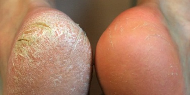 Topuk çatlaklarına evde çözüm!