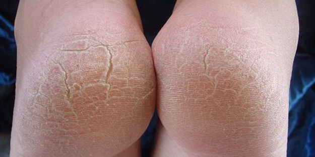 Topuk çatlaklarına ne iyi gelir?