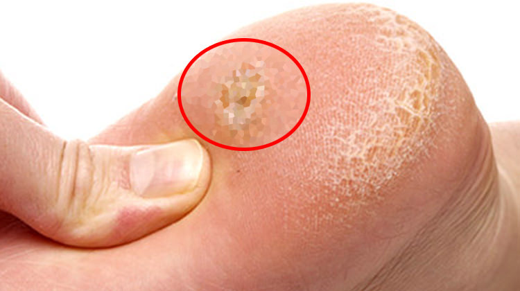 Topuk dikeni ve belirtileri nedir?