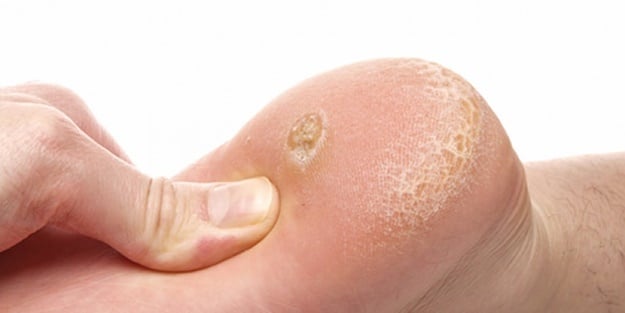 Topuk dikenine dikkat!