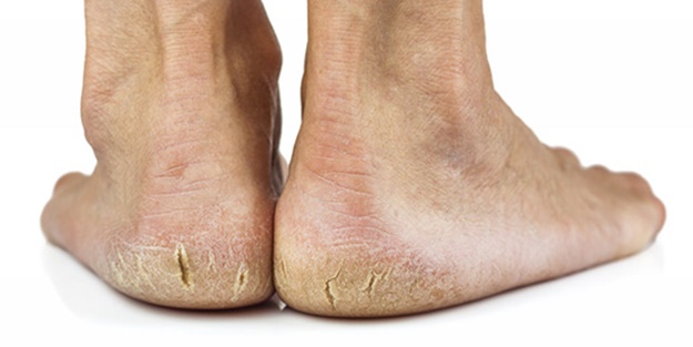 Topuklarınızdaki çatlaklardan kurtulmak için...