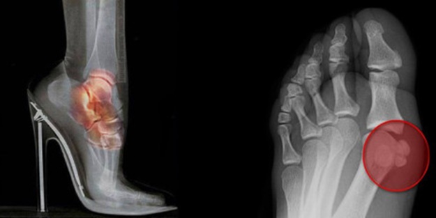 Topuklu ayakkabı sağlığı olumsuz etkiliyor