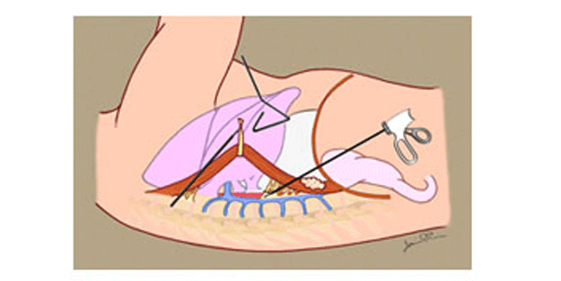 Torakoskopik nedir, nasıl tedavi edilir?