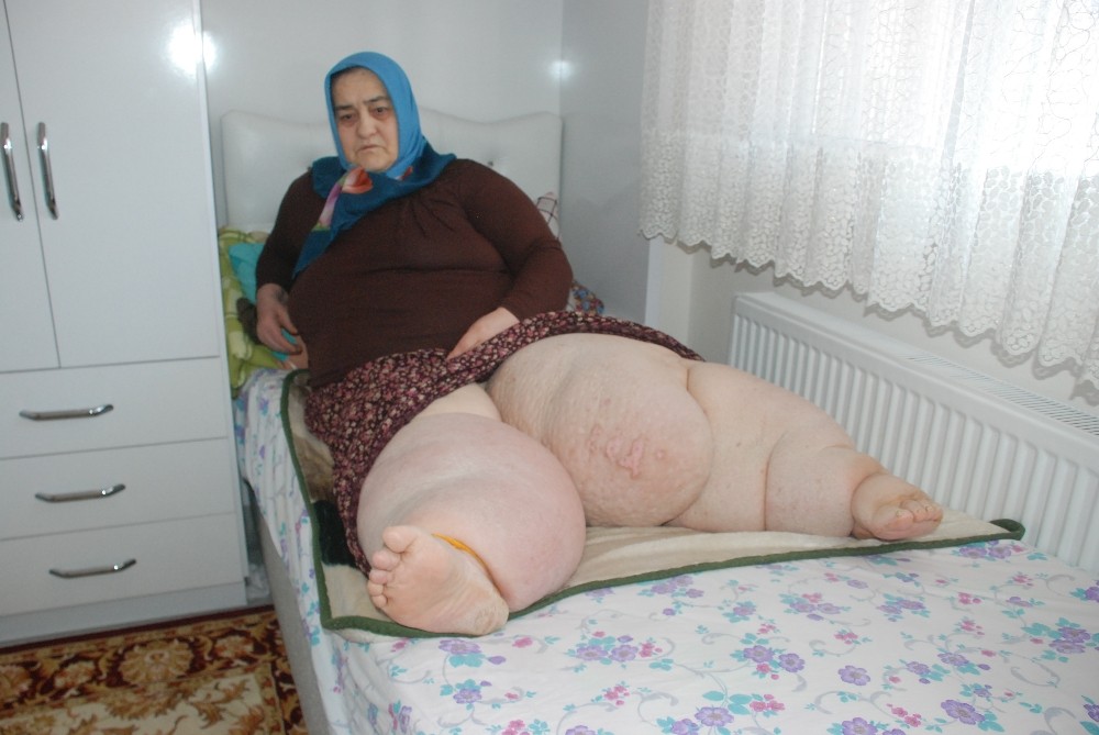 Trafik kazası sonrasında bacakları şişen kadın yaşam savaşı veriyor 