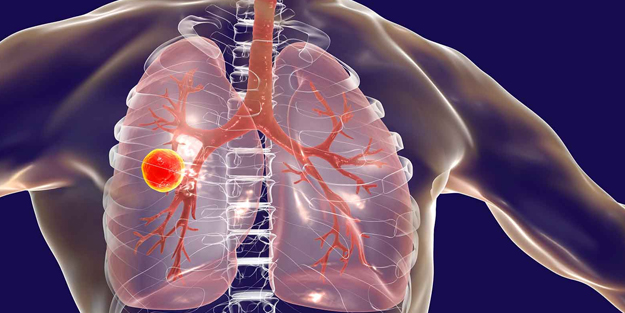 Tüberkülozda erken tanı ve tedavi çok önemli! Tüberküloz (verem) nedir ve belirtileri nelerdir?